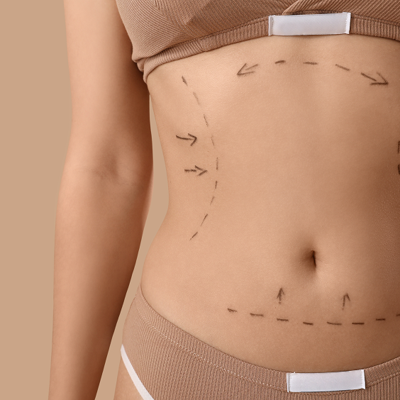 Tummy Tuck Abdominoplasty