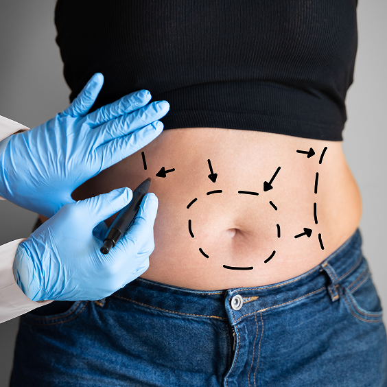 Liposuction