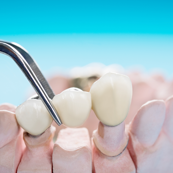 Dental Crowns and Bridges