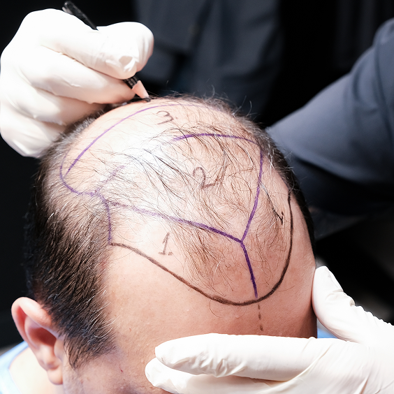 Hair Transplant Overview