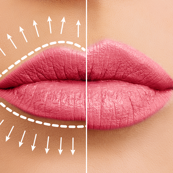 Lip Fillers Treatment