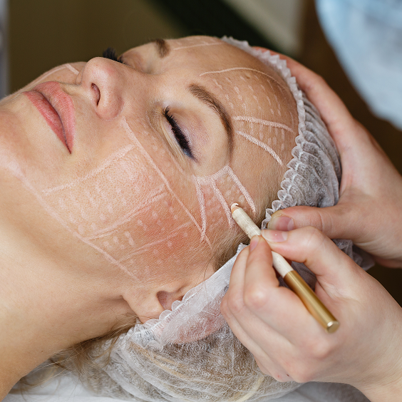 Non-Surgical Face Lifts Treatment